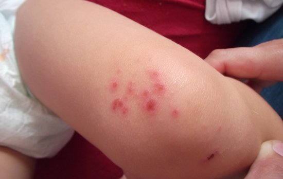 少年被猫咬后得怪病 一个月高烧昏睡不醒(图)