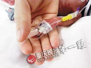 四川一新生儿仅有650克重 脑袋如鹅蛋大小(图)