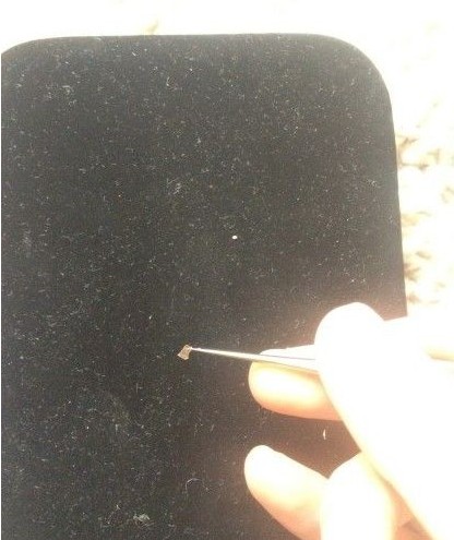 孙俪拔出嵌嘴角十年的玻璃 网友：能存那么久？