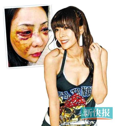 台湾靓模遭男友暴打致头骨骨折 软禁两天后逃跑