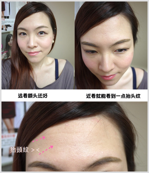 网友亲身示范肉毒小针消除抬头纹_整形