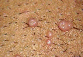 数个圆形小丘疹,如小米粒或绿豆大小,颜色如周围正常皮肤,或呈珍珠色