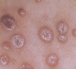 三期梅毒图片 - 皮肤病 - 39健康网