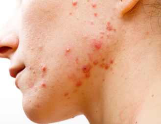 痤疮是的俗名又叫做青春痘,这是一种很常见的皮肤类疾病,徐州京城皮肤