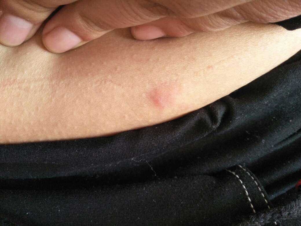 身上起了 好多红色的硬疙瘩