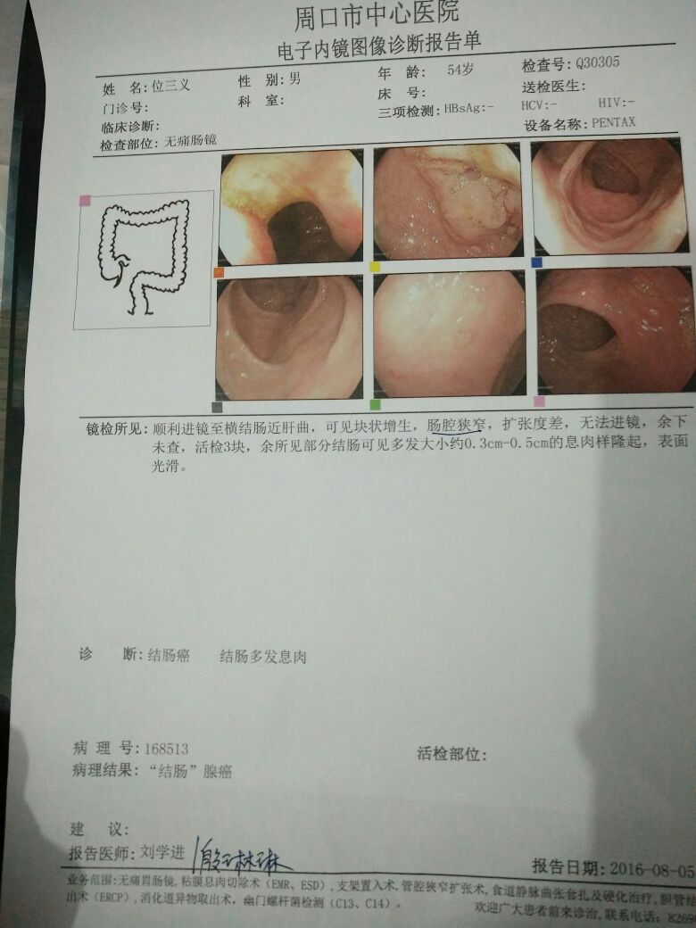 老爸54岁,刚查出结肠癌,结肠多发息肉,医生断定中晚期,让住院手术切除