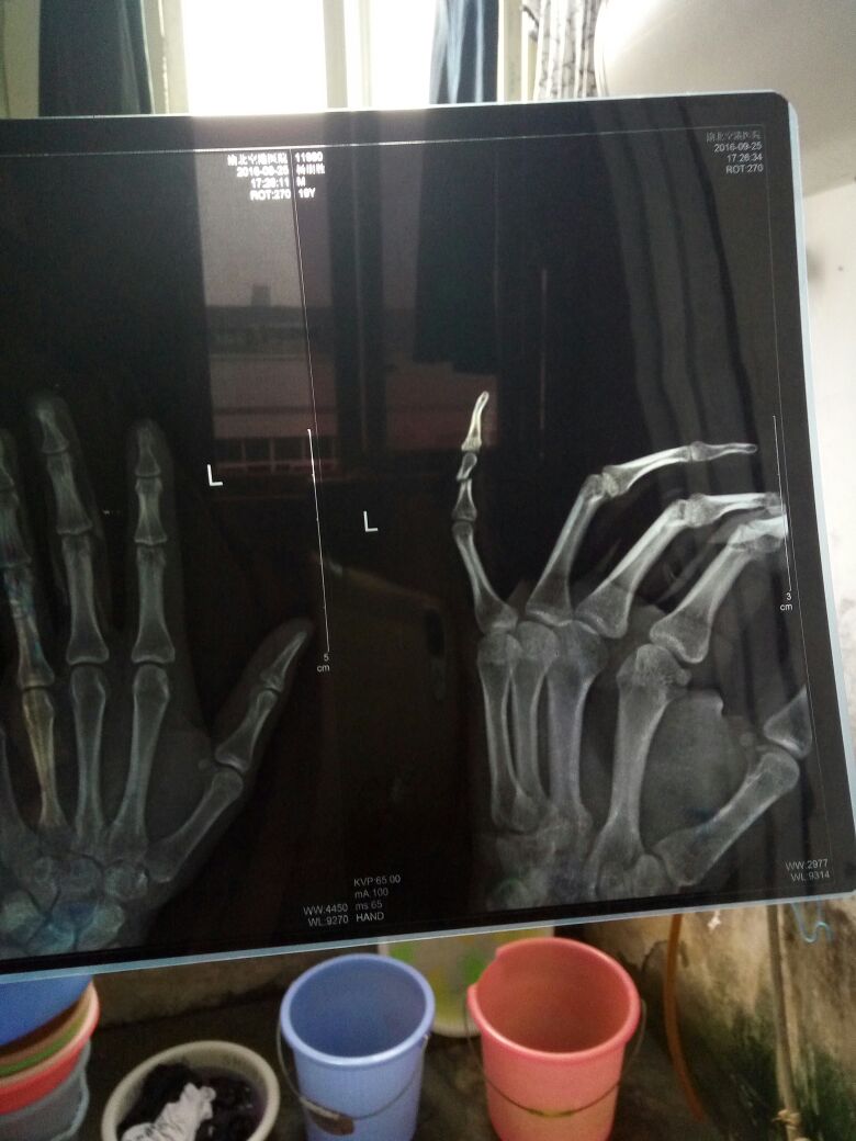 我手骨折啦工伤请问哈平残在哪