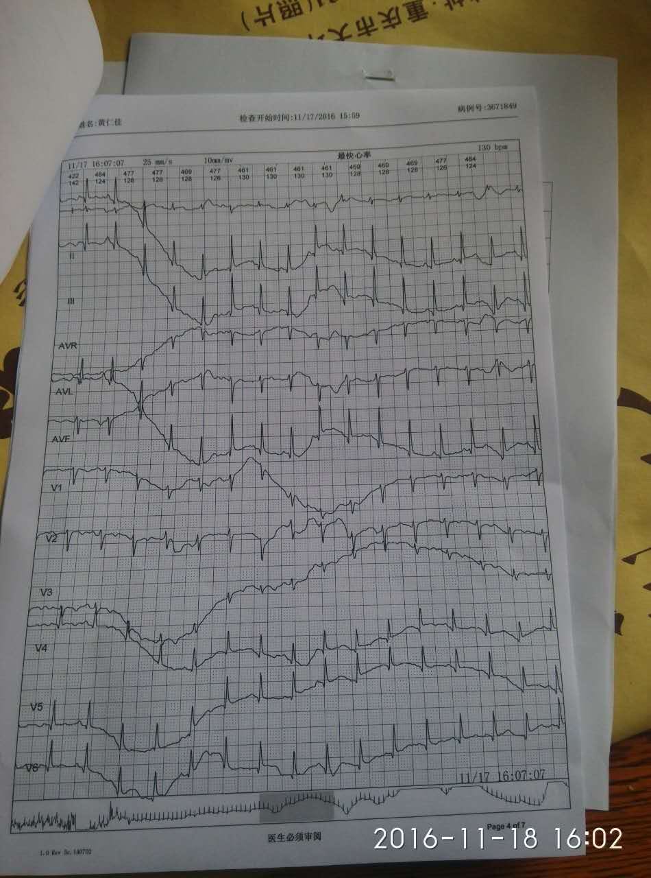 我刚做24小时心电图,正常吗?