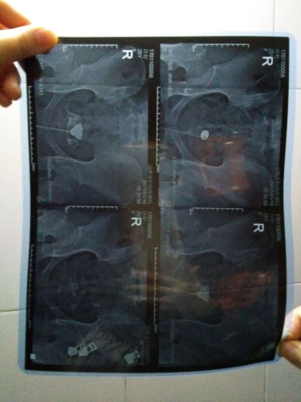 做了输卵管照影显示输卵管两边堵塞,拍的片子看不到输卵管,只看到子宫