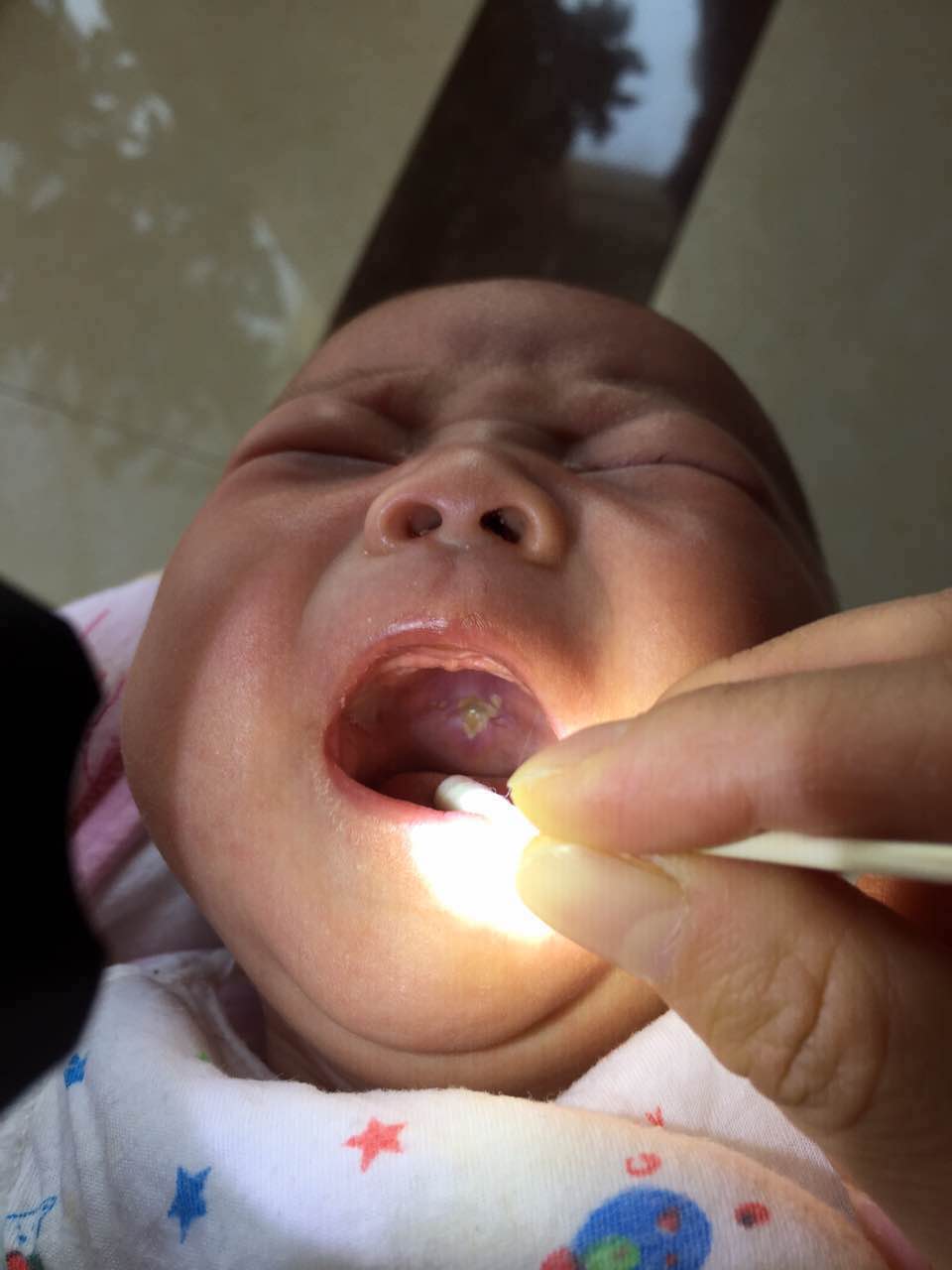 宝宝现在2个月,出生时没有注意上颚有没有缺损.