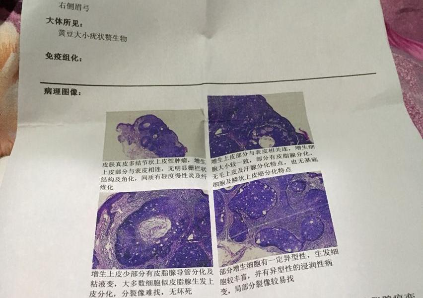 中分化皮脂腺癌变