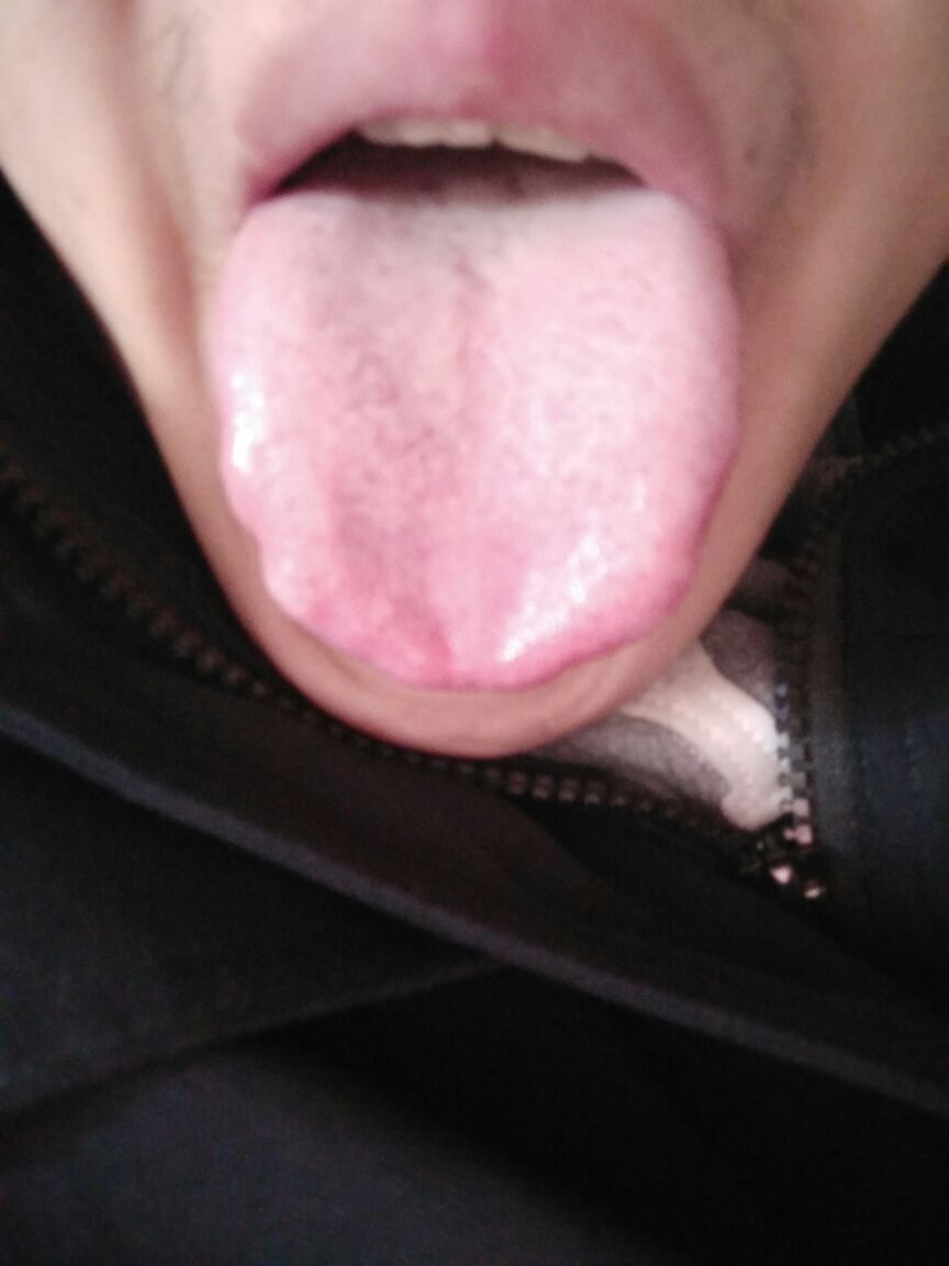 这是不是艾滋病的初期症状!