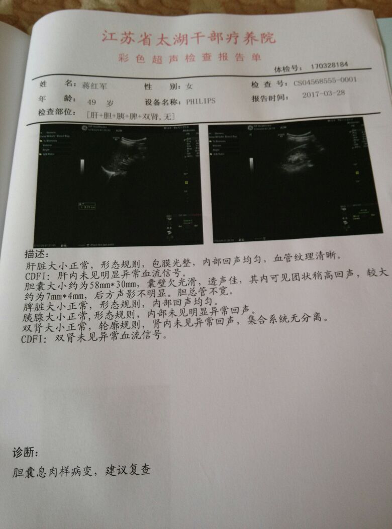 胆囊息肉样病变