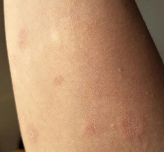 这是什么皮肤病啊?