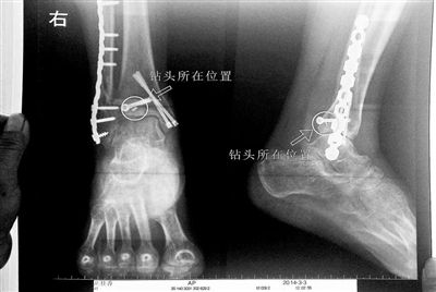 患者手术后腿里遗留钻头 院方称危害不大 患者手术后腿里遗留钻头 院方称危害不大