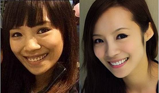 台湾知名综艺节目《大学生了没》不仅培养新生代艺人,更让身怀绝技的大学生们有展现才华的舞台,在台湾相当受到观众支持。其中有着美丽脸蛋、火辣身材的女大生茵茵,更以「芭蕾舞辣妹」在台湾闯出名号。长相甜美身材姣好的茵茵获得不少厂商亲睐,接下不少广告及于知名歌手MV中担纲女主角。 话说回来茵茵并非走来一路顺遂,起初因上节目上不顾形象,露龈大笑的模样,让人记忆深刻,不仅令茵茵羞涩不堪其扰外,甚至因笑时要遮挡牙龈,偶尔试镜时还被导演嫌做作!委屈不堪。不过在做了水激光牙整形后,不仅甩掉「小马妹」封号,成熟美艳、