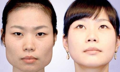胞姐胞妹组团换脸 中韩整容哪家强