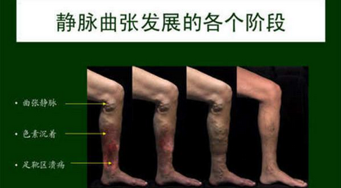 静脉曲张能彻底的根治吗 站神当心下肢静脉曲张