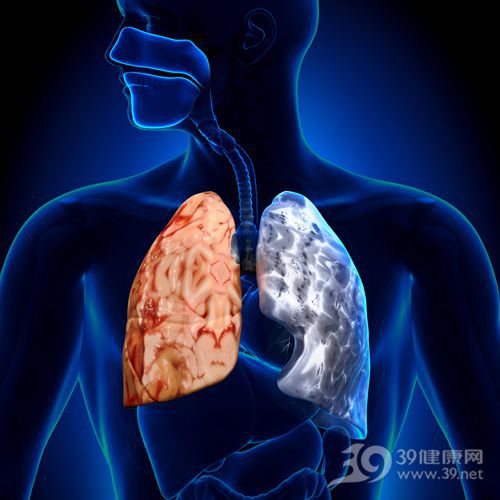 肺结核是什么病 病因和病症是什么