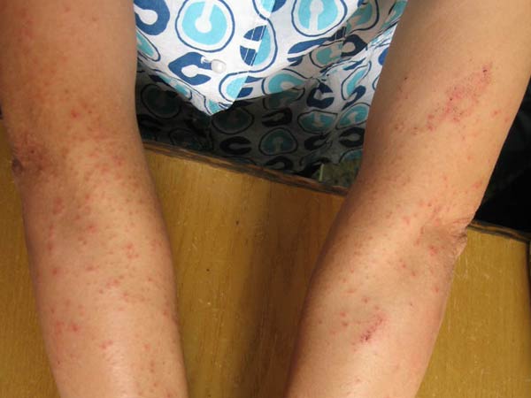 红点和脱皮等症状,专家介绍说,这就是刺激的日光性皮炎的症状