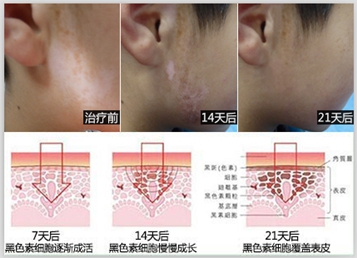 白癫疯早期图片 兰州中医白癜风医院治疗效果好吗图片 77058 357x258