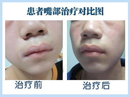 长期熬夜 小心白癜风找上门