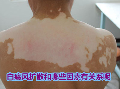 成都西部白癜风医院