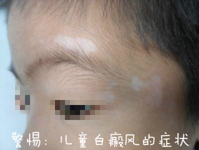 白癫疯早期图片 警惕 儿童白癜风的症状图片 26246 398x300