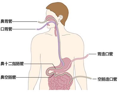 肠内营养ppt_一文拿下肠外营养与肠内营养