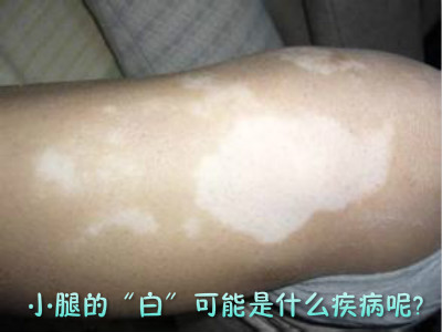 皮肤发白是一种常见现象,很多人会忽视皮肤的小小变化,但近几年白癜风