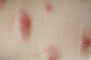 荨麻疹是一种因为发生过敏导致的种皮肤变态性反应的皮肤病.