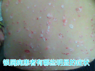 下面就请 北京方舟皮肤病医院银屑病专家为我们介绍一下