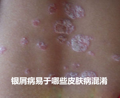 银屑病易于哪些皮肤病混淆?
