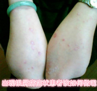 下面就由 北京方舟皮肤病医院银屑病专家为我们介绍一下