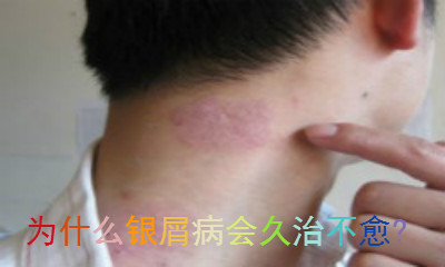 银屑病是皮肤疾病中比较常见的一种,银屑病本身就非常难至于,疾病的