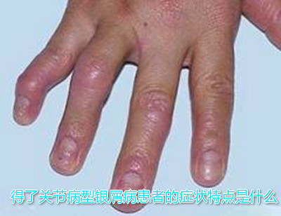 皮肤病 方舟银屑病 牛皮癣症状    得了关节病型银屑病患者的症状特点