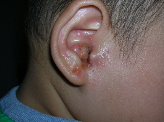 耳朵痒可能是外耳道炎,也