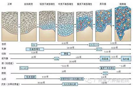 图5从癌前期病变发展到原位癌再到侵袭性癌的过程,大致所需时间