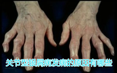 方舟银屑病 牛皮癣病因    关节型银屑病发病的原因有哪些?
