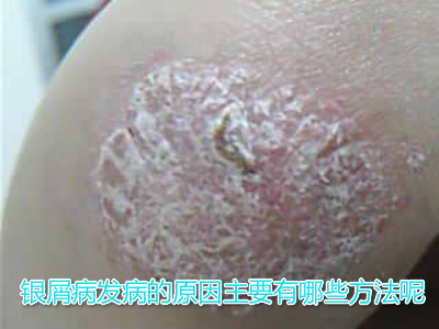 方舟银屑病 牛皮癣病因    银屑病发病的原因主要有哪些方法呢?