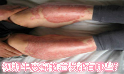 皮肤病,很多人对此都敬而远之,下面专家就牛皮癣早期症状是什么这个