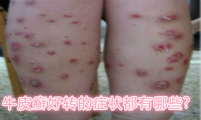 牛皮癣好转的症状都有哪些?
