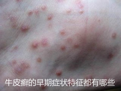 牛皮癣的早期症状特征都有哪些?