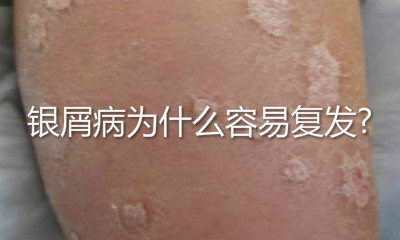 银屑病为什么容易复发?