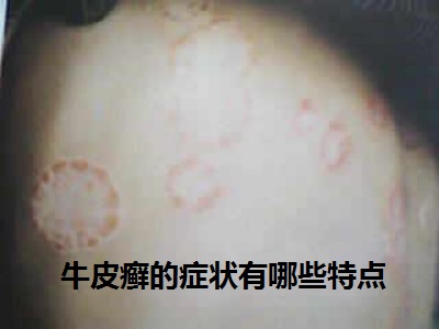 牛皮癣的症状有哪些特点