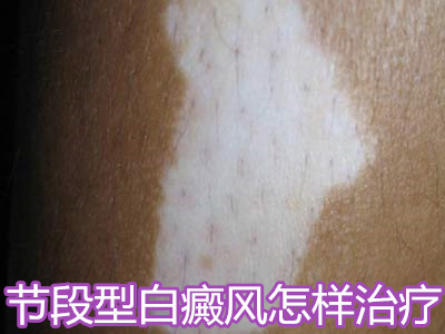 节段型白癜风怎样治疗?