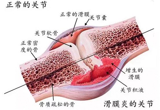 滑膜炎:膝盖疼得像中了箭!破除它的妙招在这里!