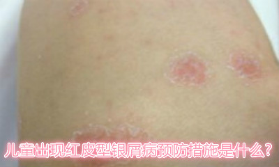 皮肤病 方舟银屑病 牛皮癣预防     儿童出现红皮型银屑病预防措施是