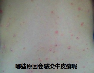哪些原因会感染牛皮癣呢