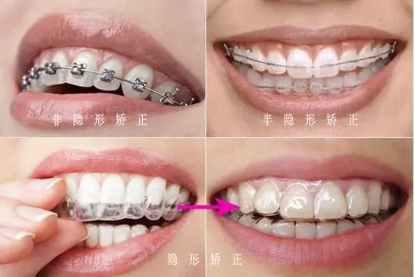 上海矫正牙齿效果如何